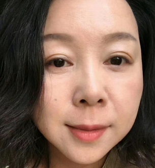 去眼袋手术