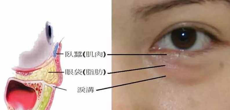 去眼袋手术