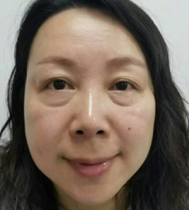 去眼袋手术