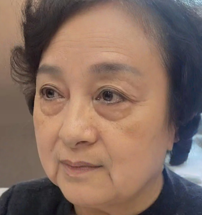 去眼袋手术