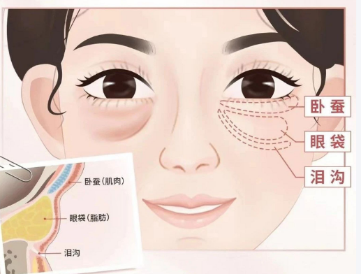 去眼袋手术