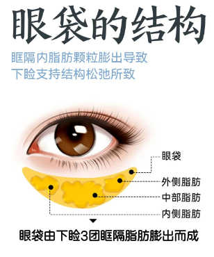 去眼袋手术