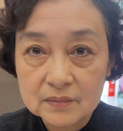 去眼袋手术