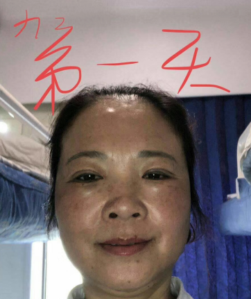 去眼袋手术
