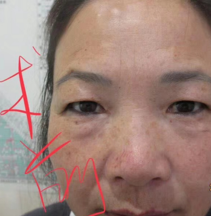 去眼袋手术