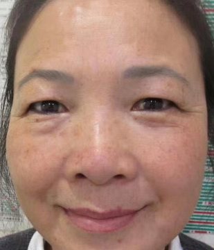 去眼袋手术