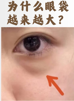 去眼袋手术