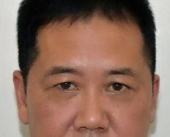 去眼袋手术