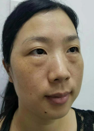 去眼袋手术