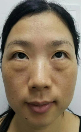 去眼袋手术