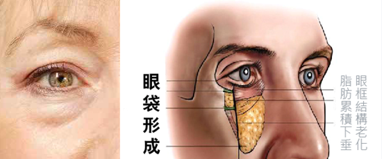 去眼袋手术