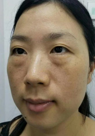 去眼袋手术