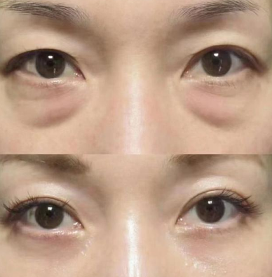 去眼袋手术