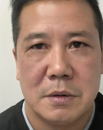 去眼袋手术
