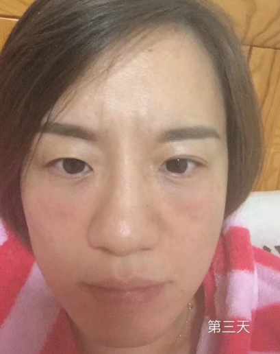 去眼袋手术