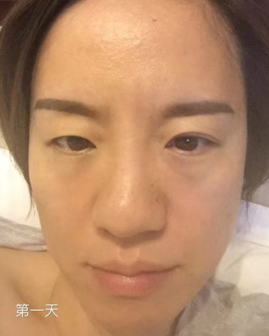去眼袋手术