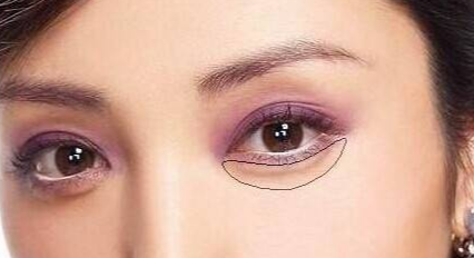 去眼袋手术