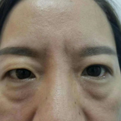 去眼袋手术