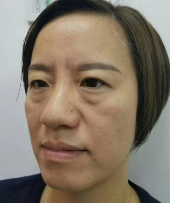 去眼袋手术