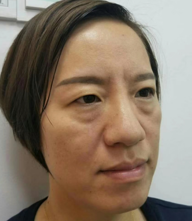 去眼袋手术