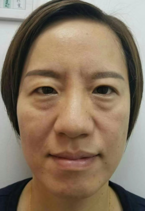 去眼袋手术