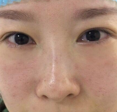 去眼袋手术