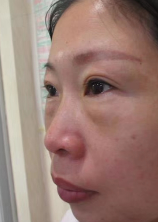 去眼袋手术