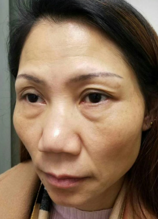 去眼袋手术