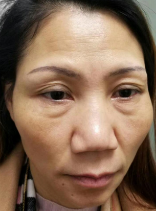 去眼袋手术