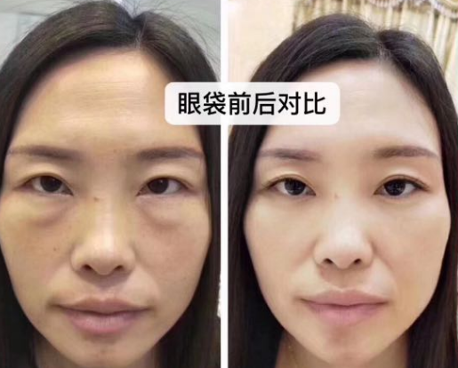 去眼袋手术