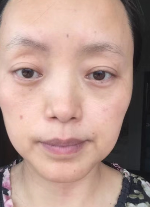 去眼袋手术