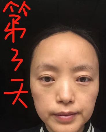 去眼袋手术