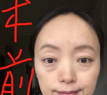 去眼袋手术