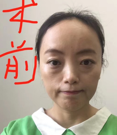 去眼袋手术