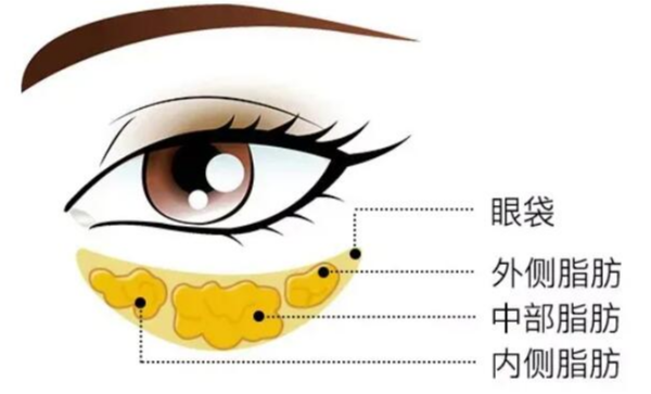 去眼袋手术