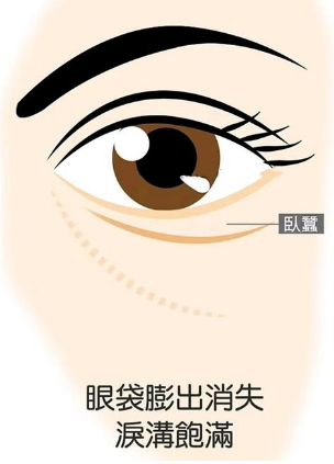 去眼袋手术