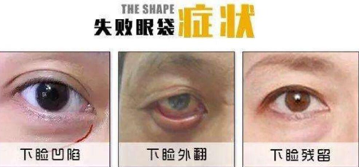去眼袋手术