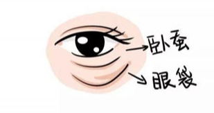 去眼袋手术