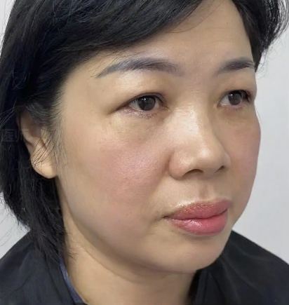 去眼袋手术