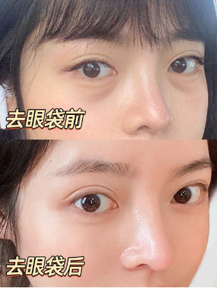 去眼袋手术