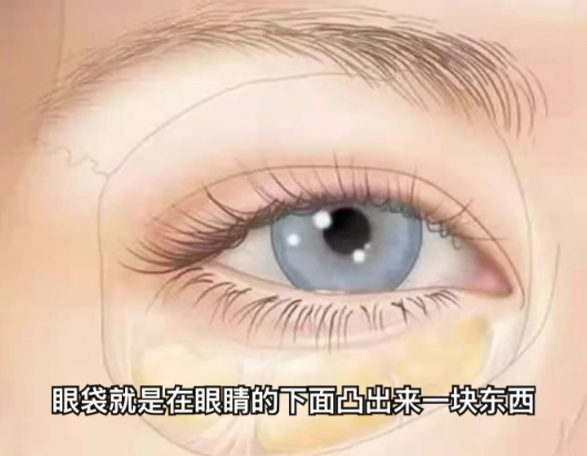 去眼袋手术