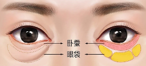 去眼袋手术