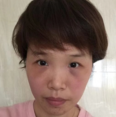 去眼袋手术
