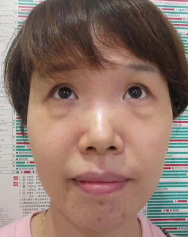 去眼袋手术