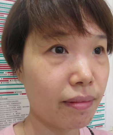 去眼袋手术