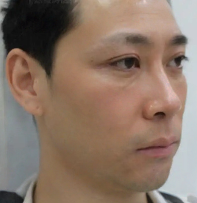 去眼袋手术
