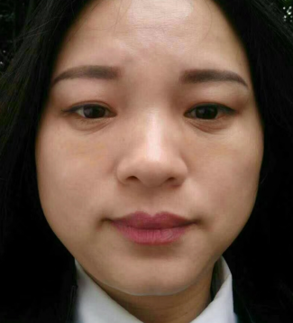 去眼袋手术