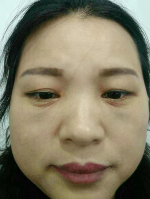 去眼袋手术