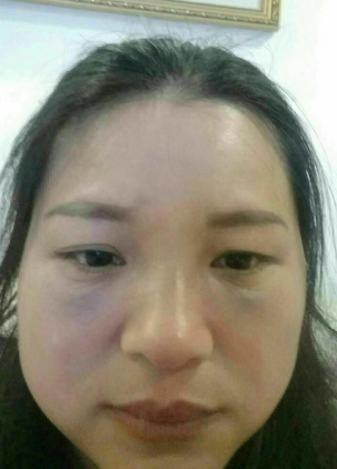 去眼袋手术