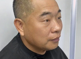 去眼袋手术